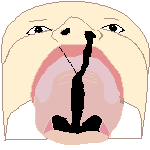 Односторонняя расщелина нёба и верхней губы