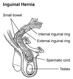 Файл:Inguinalhernia.gif