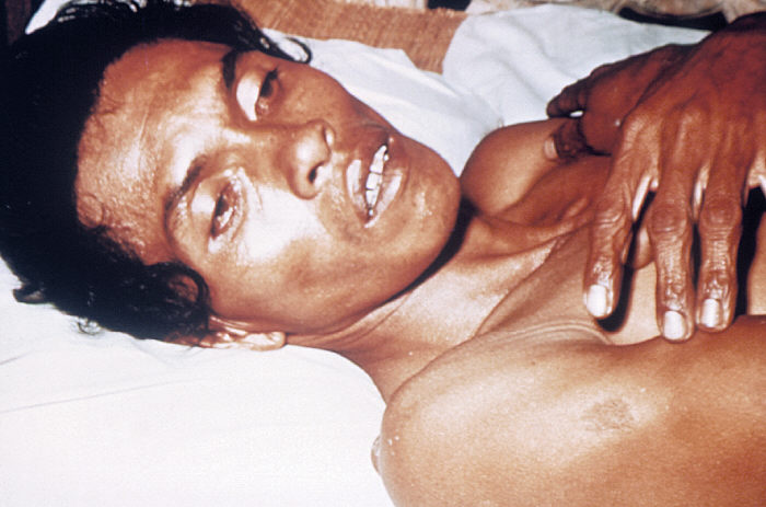 Файл:Adult cholera patient.jpg