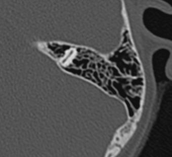 Файл:CTpneumatisation1.jpg