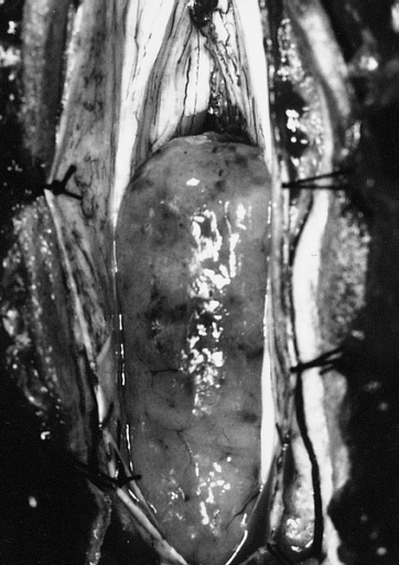Файл:AFIP405714G-MYXOPAPILLARY EPENDYMOMA.jpg