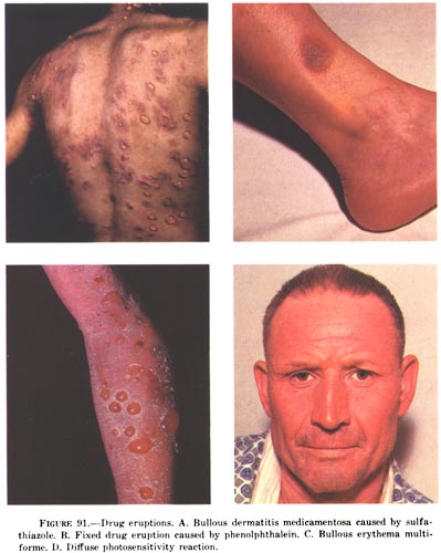 Файл:Drug eruptions.jpg