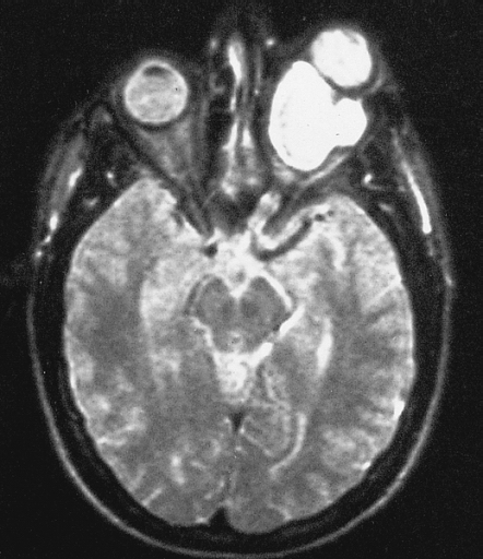 Файл:Optic glioma.jpg