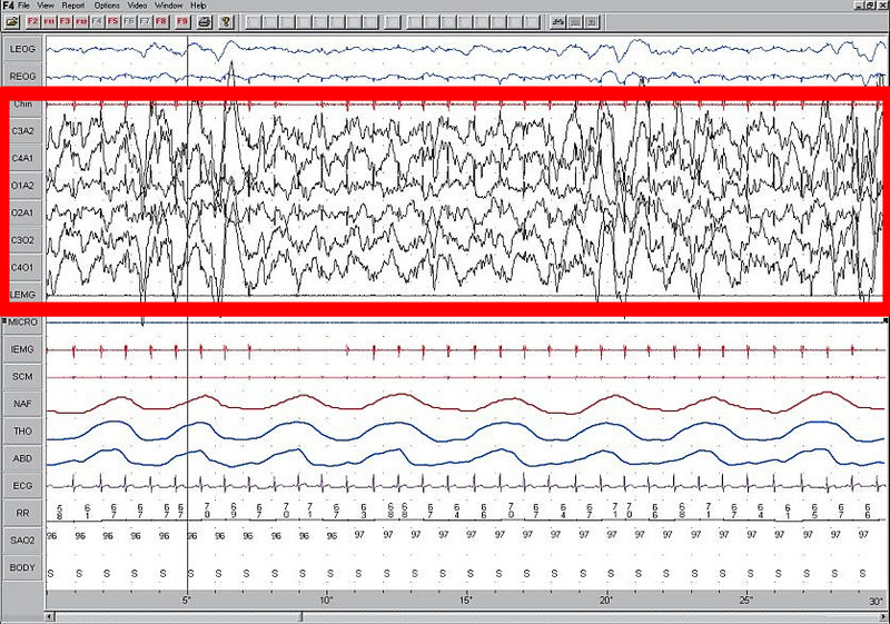 Файл:Screen shot of a patient during Slow Wave Sleep.jpg
