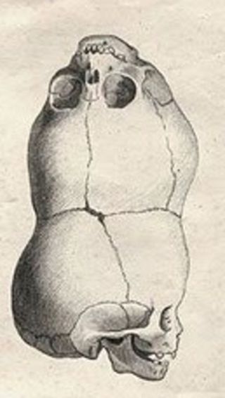 Файл:CraniopagusParasiticus.jpg