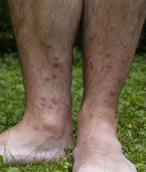 Файл:Cercarial dermatitis lower legs.jpg