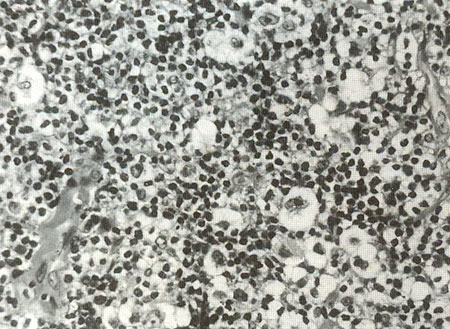 Файл:Lakunar cells.jpg