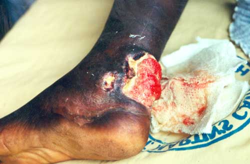 Файл:Buruli ulcer left ankle EID.jpg