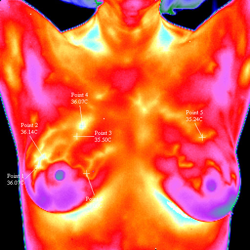 Файл:BreastCancerRightSamplel.jpg