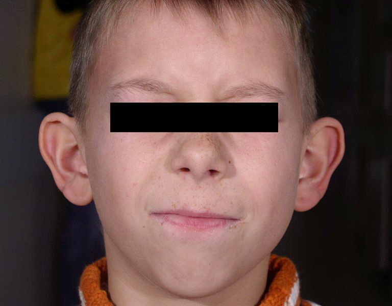 Файл:Otopexy prae.jpg