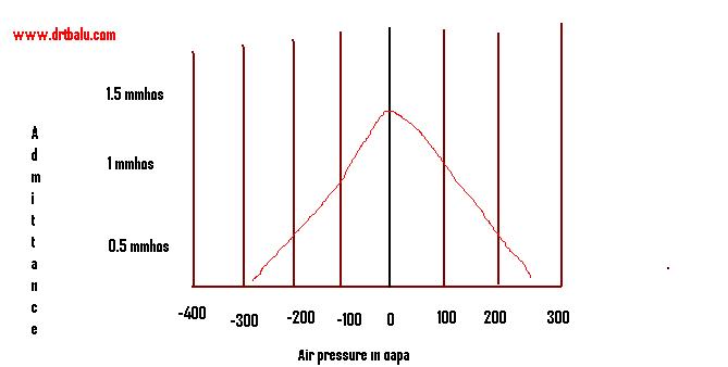 Файл:Tympanometry Type a.jpg