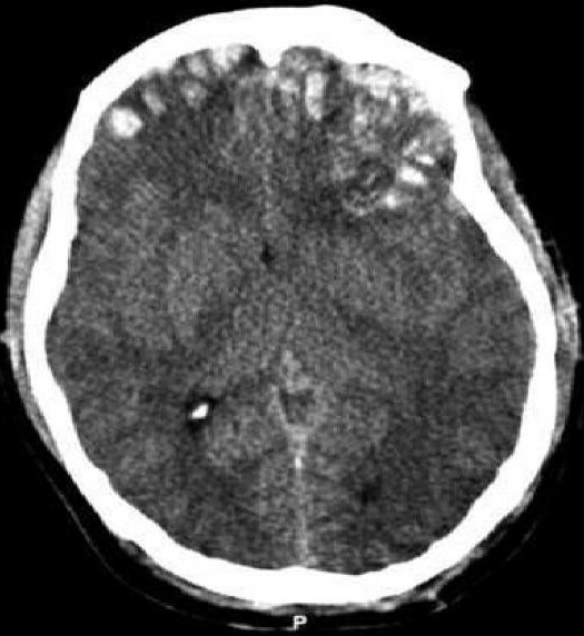 Файл:Brain trauma CT.jpg