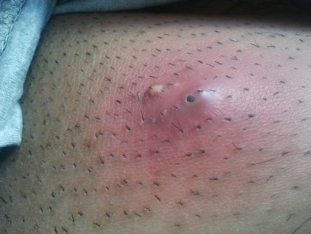 Файл:Five day old Abscess.jpg