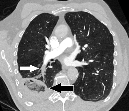 Файл:CT of lung infarction with reverse halo sign, annotated.png