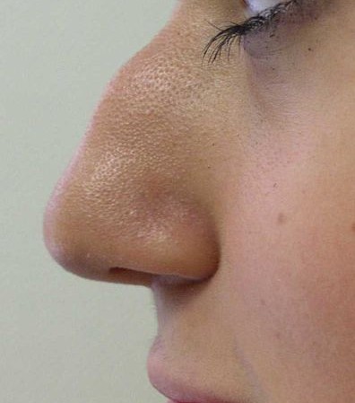 Файл:Hump nose2.jpg