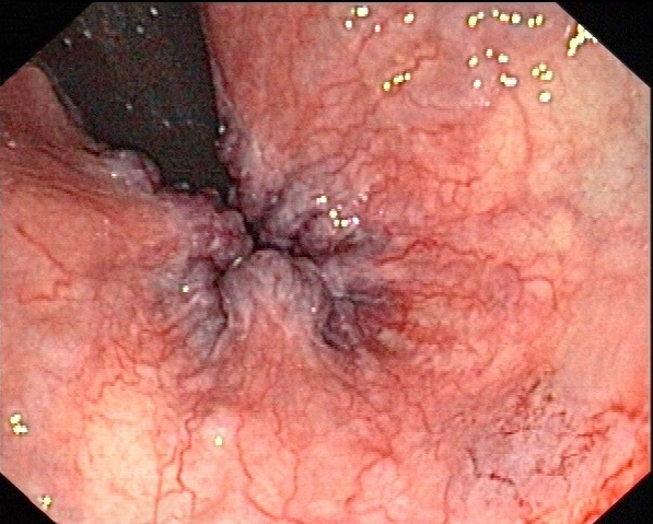 Файл:Haemorrhoiden 1Grad endo 01.jpg