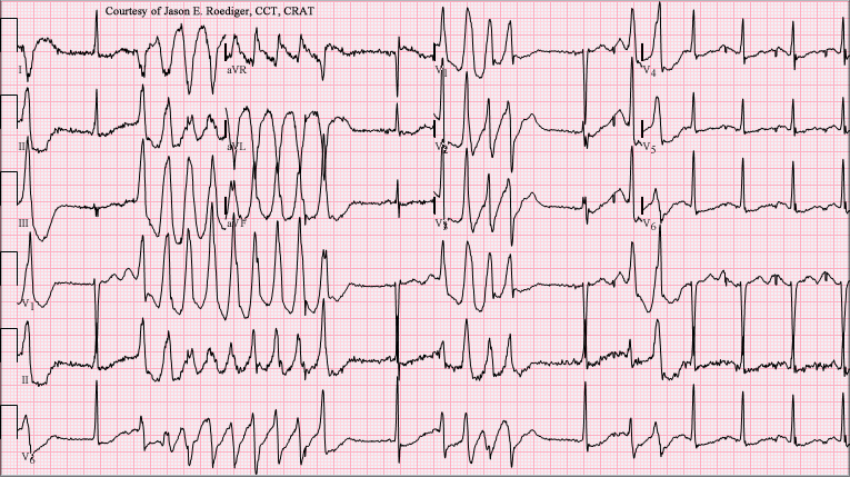 Файл:Torsades de Pointes TdP.png