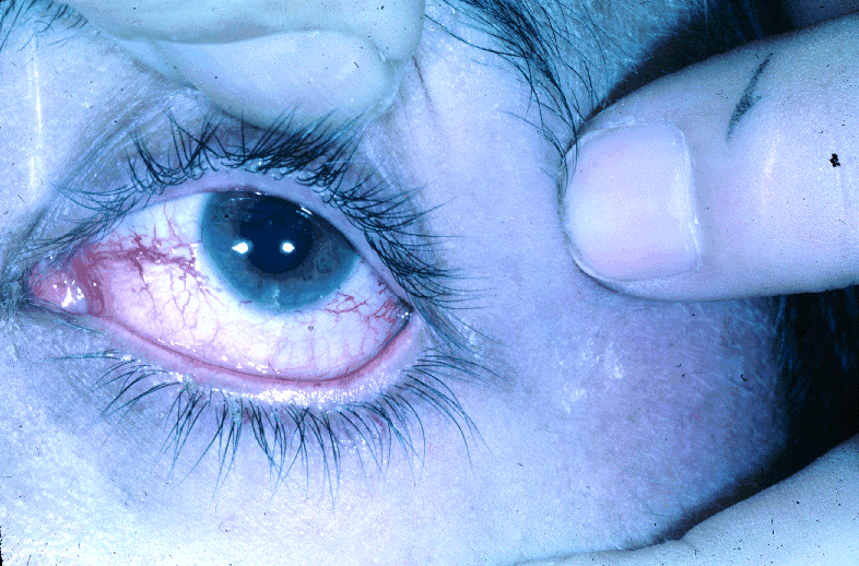 Файл:Ataxia-telangiectasia2.png