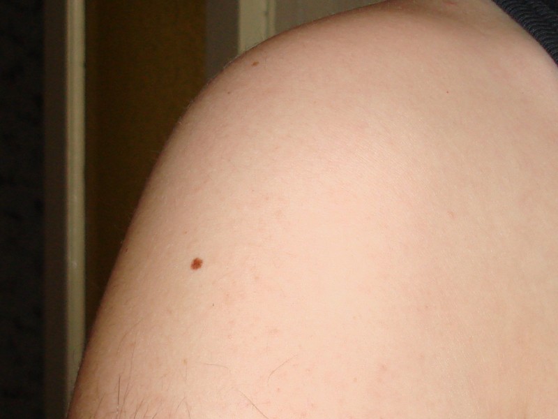 Файл:Nevus.jpg