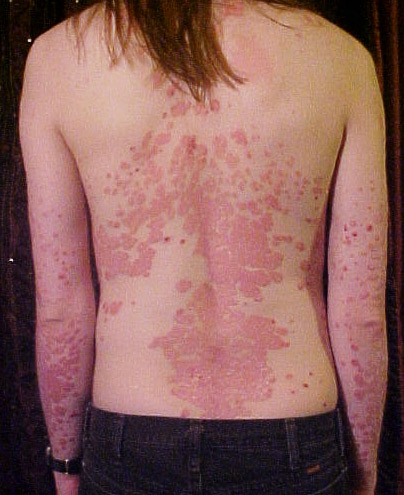 Файл:Psoriasis on back.jpg