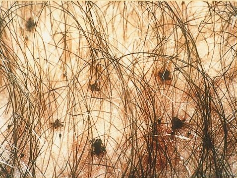 Файл:SOA-Pediculosis-pubis.jpg