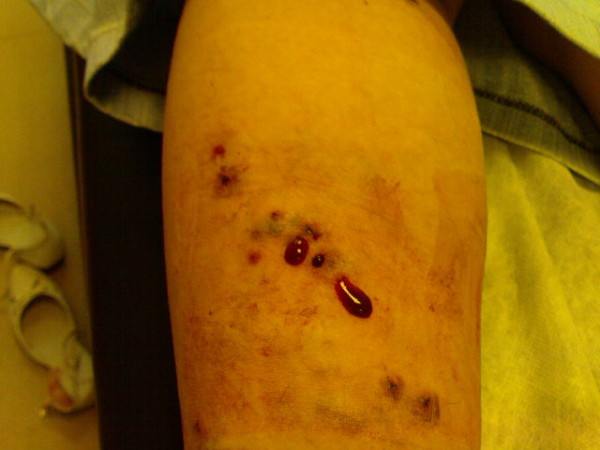 Файл:Bleeding after leech bite.jpg