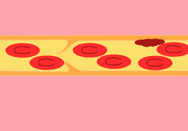 Файл:Thrombosis formation.gif