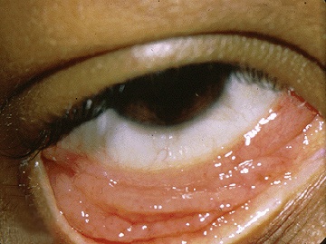 Файл:Chlamydial-conjunctivitis.jpg