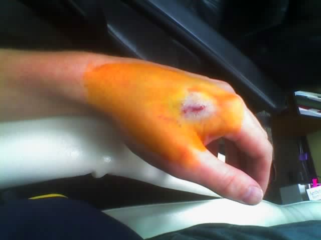 Файл:RFID hand 2.jpg
