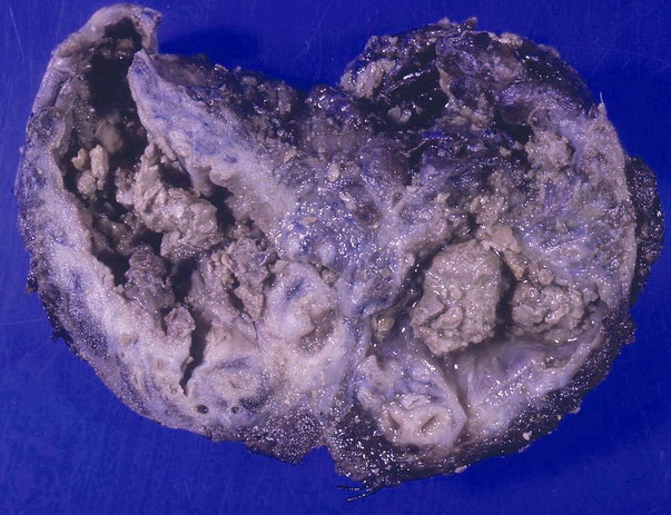 Файл:Aspergillomas complicating tuberculosis.jpg