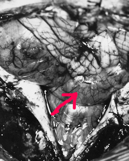 Файл:Ependymoma of posterior fossa.jpg