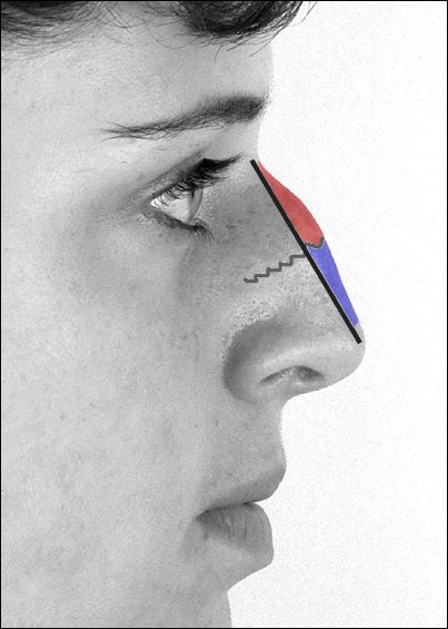 Файл:RhinoplastyProfileHump.jpg