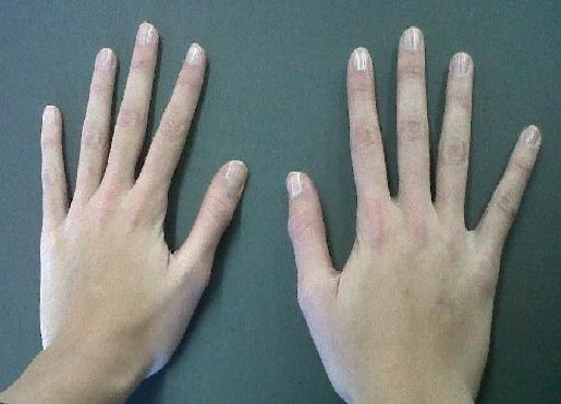Файл:Aracnodactilia.jpg