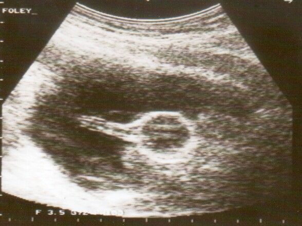 Файл:Ultrasound Scan ND 013.jpg