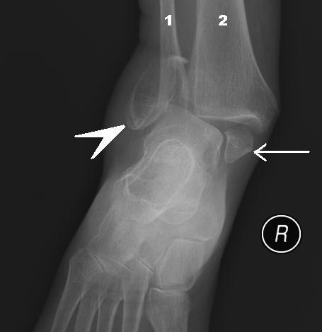 Файл:Bimalleolar fracture legend.jpg