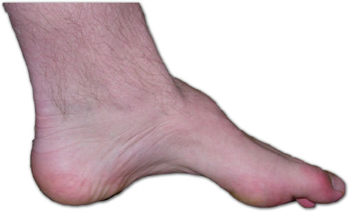 Файл:Charcot-marie-tooth foot.jpg