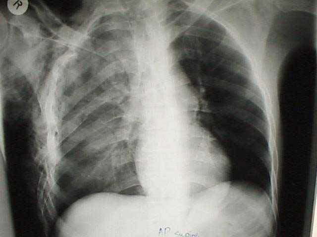 Файл:Pulmonary contusion.jpg