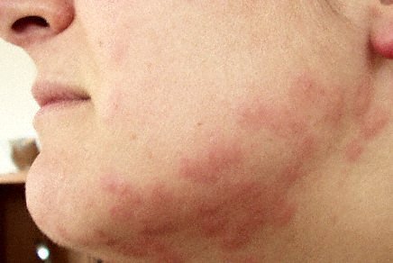 Файл:Bedbug bites.jpg