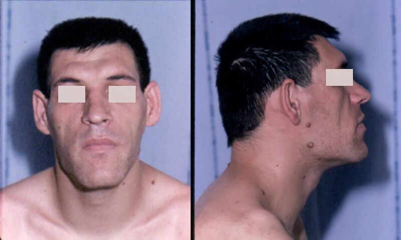 Файл:Acromegaly facial features.JPEG
