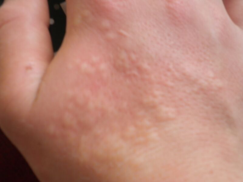 Файл:Nettle Sting.JPG