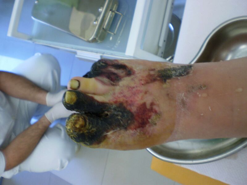 Файл:Chronic wound.JPG