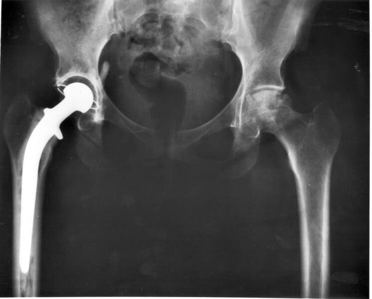 Файл:Hip replacement Image 3684-PH.jpg