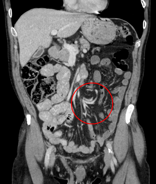 Файл:Volvulus.PNG