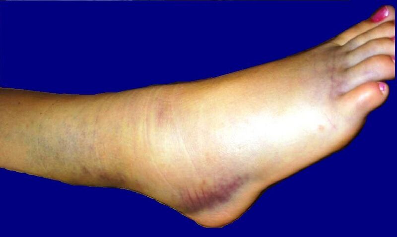 Файл:ANKLE SPRAIN 02b.JPG