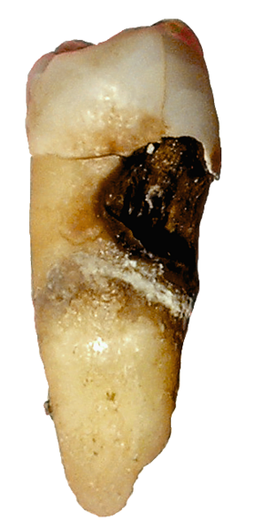 Файл:Toothdecay.png