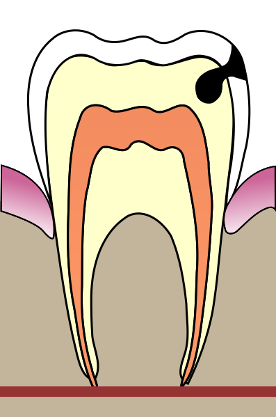 Файл:Cavities evolution 3.svg