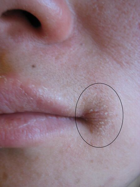 Файл:Angular Cheilitis.JPG