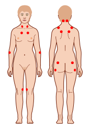 Файл:Tender points fibromyalgia.svg
