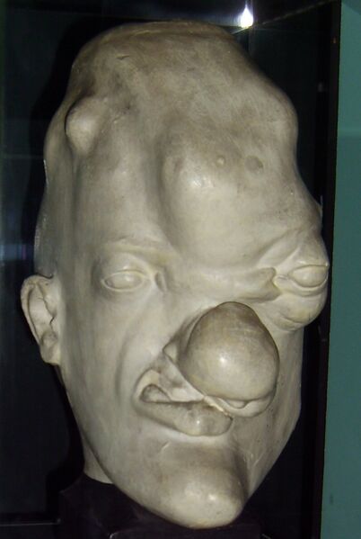 Файл:Tertiary syphilis head.JPG