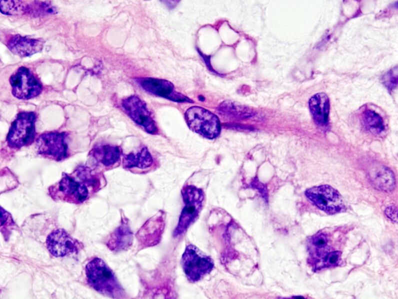 Файл:Myxoid liposarcoma (06).JPG